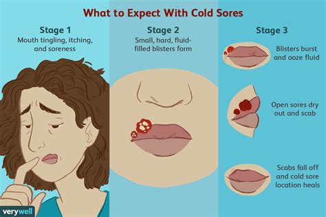 cold sore pics stages|pictures of herpes inside mouth.